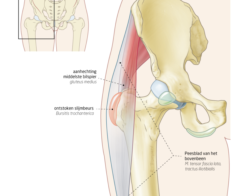 Slijmbeursontsteking Heup Het Fysiohuis