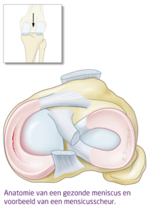 gescheurde-meniscus-het-FysioHuis