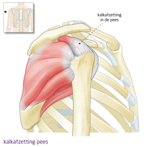 kalkafzetting-pees-het FysioHuis