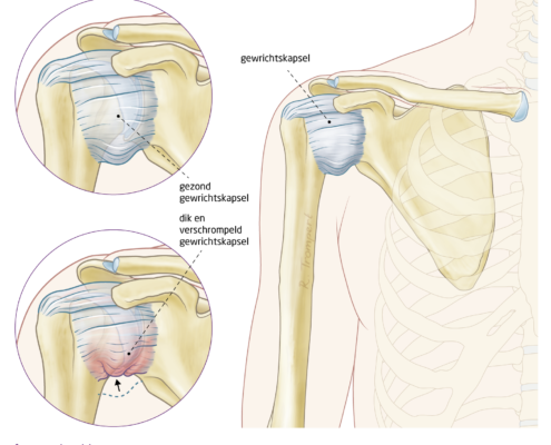 frozen-shoulder - het FysioHuis