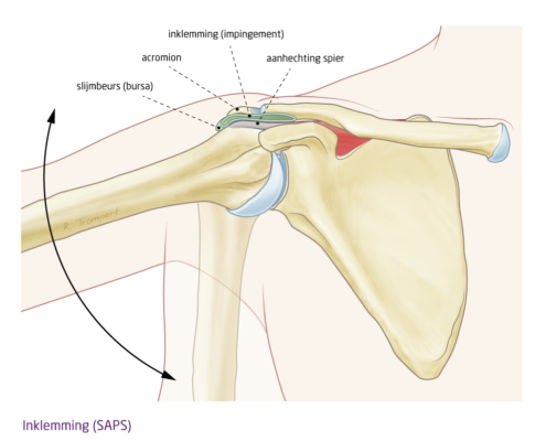 impingement slijmbeurs - het FysioHuis