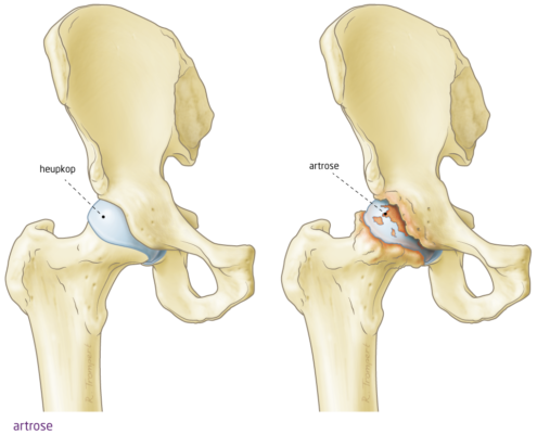 artrose heup - het FysioHuis